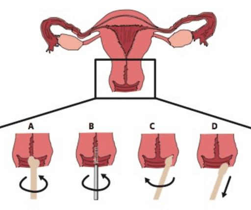 Exame Ginecológico: Esquema representativo de coleta cérvico-vaginal. 