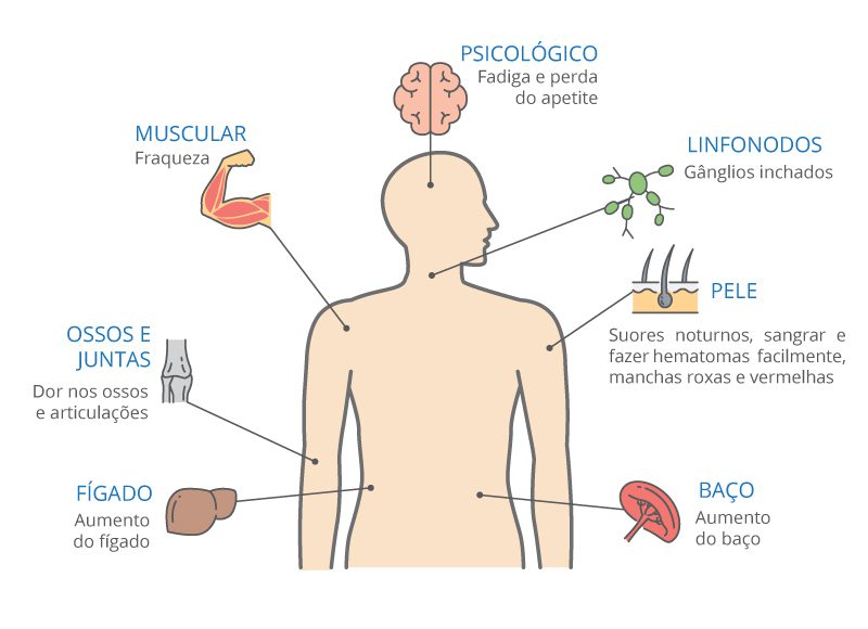 sintomas de leucemia